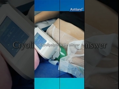 Có bao nhiêu khu vực có thể làm cryolipolysis