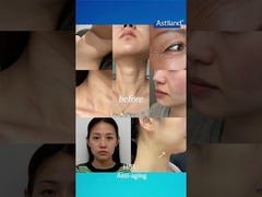 Tác dụng đáng chú ý của HIFU