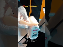 chứng kiến sức nâng không xâm lấn của HIFU