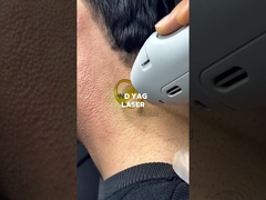 Xóa lông bằng laser ND YAG cho tóc đen