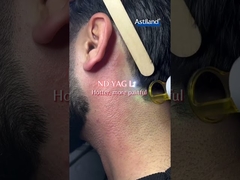 Diode Laser vs ND YAG Laser, anh thích cái nào hơn?