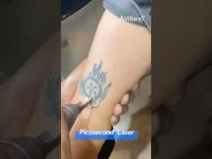 Laser picosecond để xóa hình xăm