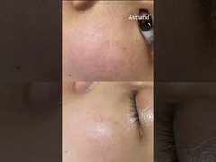 Hydra điều trị da cho chăm sóc da nhạy cảm