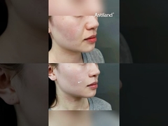 Bạn đã thử RF + HIFU để làm cứng da chưa? #AntiAging #SkinLift #beautyclinic #facialtreatment